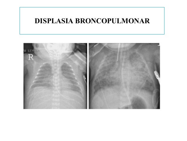 broncodisplasia pulmonar pediatria